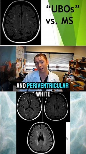 MS MRI Lesions vs. "benign" White Matter Lesions