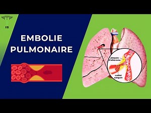 Embolie Pulmonaire Aigue (Facteurs de Risques / Signes Cliniques / Diagnostique / Traitement)