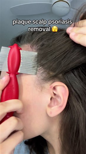 Scalp Psoriasis Removal: Satisfying Before and After