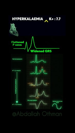 🚨 Hyperkalemia : ECG Essentials 🚨 ✔️ HyperK: Peaked T → Sine wave → Cardiac arrest. Watch how increasing potassium levels affect the heart. As K rises, notice these ECG changes: Flattened P Wave: Impaired atrial depolarization. Widened QRS Complex: Delayed ventricular depolarization. These changes can lead to severe arrhythmias and potentially cardiac arrest if not treated promptly. #Hyperkalemia #Cardiology #ECG #MedicalEducation #CardiacArrest #Healthcare👇🏻 Save 📌 | Share 🔗 | Tag a colle