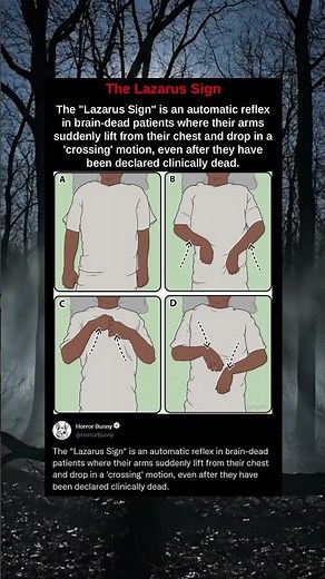 The "Lazarus Sign" is an automatic reflex in brain-dead patients where their arms suddenly lift from