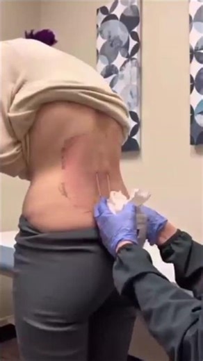 spinal stimulator device 😱#facts