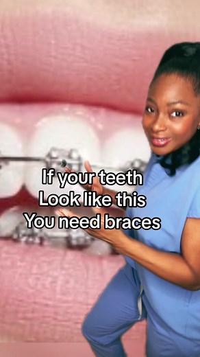 Signs You Need Braces: How to Know If Your Teeth Require Braces