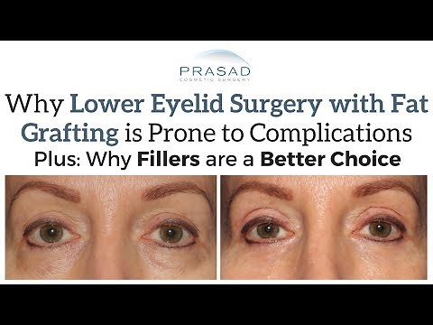 Why Fat Grafting Under Eyes is Prone to Complications, and Preventing Hollowness in Eye Bag Surgery