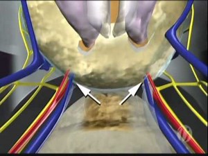 Introduction To The Prostatectomy For Prostate Cancer • Video • MEDtube.net