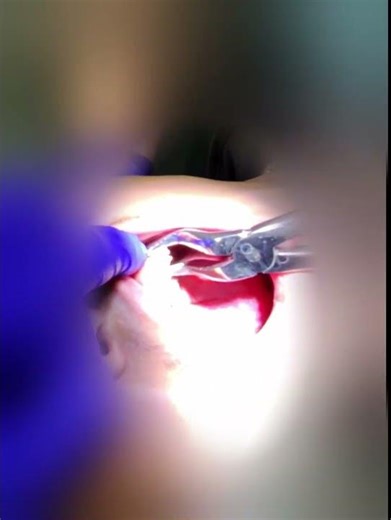 First Maxillary Premolar Extraction ‪@DentistPOV‬