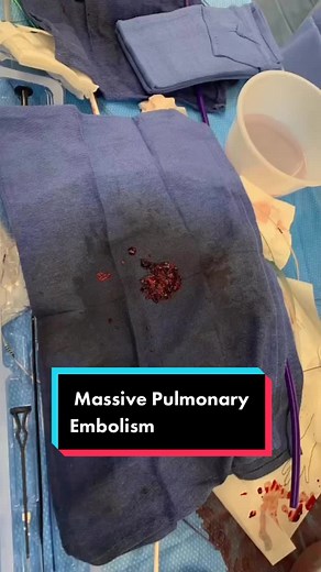 This is a massive pulmonary embolism from a lower extremity DVT that was treated with mechanical thrombectomy using the Inari device. This device has been an absolute game changer! There is only so much fibrinolytics can do! Check out the patients before & after PaO2 levels & PA pressures: PaO2 - before: 32.6 after: 50.6 PA pressures - before: 63/23 (40) after: 33/17 (23) Pretty amazing! # pulmonaryembolism #nurse #nurselife #criticalcare #criticalcarenurse #cathlab #interventionalist #emergency