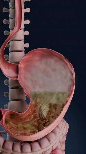 Visualización 3D de la distensión abdominal: ¿qué está ocurriendo en tu cuerpo?