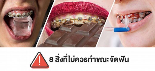 อาหารต้องห้าม และพฤติกรรมที่เสี่ยงของคนจัดฟัน | COSDENT
