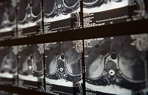 Cervical Interlaminar Epidural Steroid Injection | Pain Intervention Center