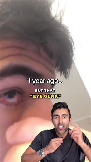 Eye mucus helps keep your eyes clean, but pulling it out can do more harm than good. The habit, called mucus fishing, can irritate the surface of the eye and lead to more mucus, infections, or even long-term damage. Have you heard of this before? VC: @68omerr Follow @doctorsoood to improve your health IQ and for similar content. #eyemucus #eyehealth #ophthalmology #mucusfishing #medical