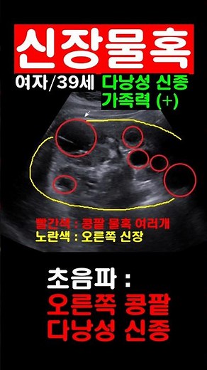 신장물혹 다낭성신종 초음파 진단
