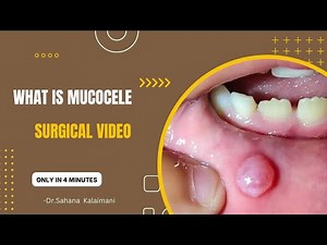 what is mucocele along with surgical procedure video | Dentist |