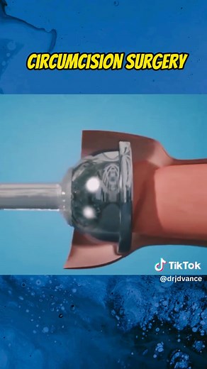 circumcision surgery procedure animation 3d medical visualization for anatomy education. Educational medical 3D animation For learning purposes only Non-graphic. Not real footage #healtheducation #circumcision #circumcissionsurgery #circumcisedscars #zsrcircumcusion