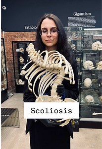 Idiopathic Scoliosis: Sideways Spinal Curvature Explained