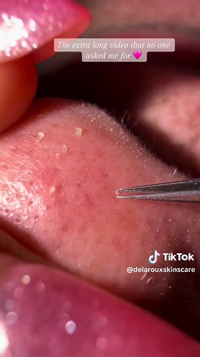 Sebaceous Filaments Extraction with Tweezers