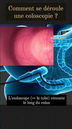 Coloscopie : les images ! #coloscopie #endoscopie #docteur #santé #gastro