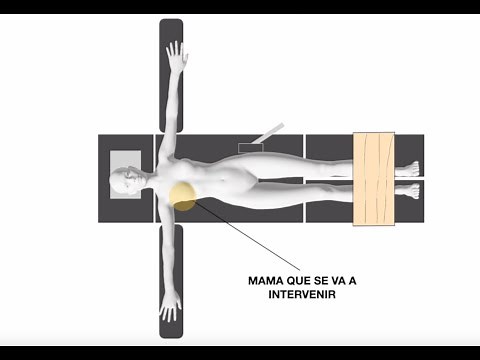 Posición para mastectomía con y sin reconstrucción