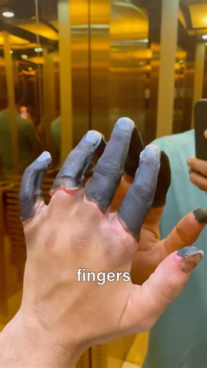 This Is What Frostbite Really Looks Like #Frostbite