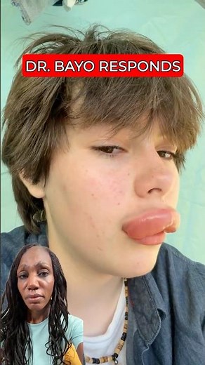 His Lip Kept Growing "By the Second" After a Bee Sting — When It's an Emergency #BeeSting