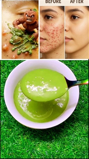 Easy homemade beauty tips for beautiful glowing skin Acne-Free Skin #shorts #beautytips