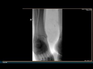 Lower Extremity Angiogram