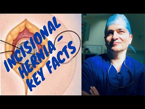 Incisional Hernia - Key Facts