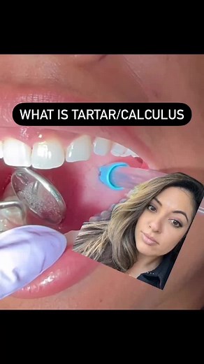 Calculus (tartar) is a hardened film of bacteria mixed with salivary minerals. The bacteria in the calculus matrix release cytotoxins which attack tissue and collagen resulting in inflammation (or gum disease) Once plaque hardens into calculus, it cannot be brushed or flossed off but needs to be professionally scraped off with special instruments. Calculus tends to sit lower and lower beneath the gum like (as is the case in this video). But on a scale from 1- satisfying how satisfying is it to w