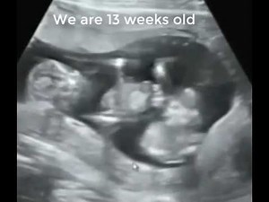 TWIN BOY GENDER @13 WEEKS! 3D/4D BABY ULTRASOUND.. A NEW CONCEPTION ULTRASOUND STUDIO IN MA
