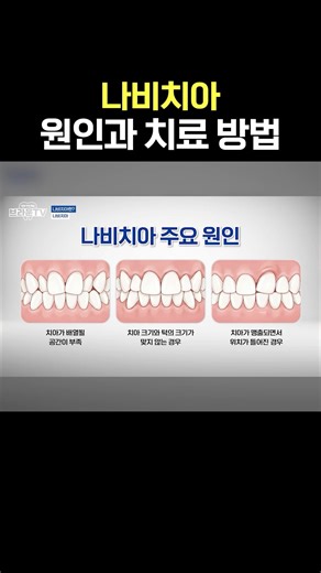 Causes and Treatment Methods for Butterfly Teeth