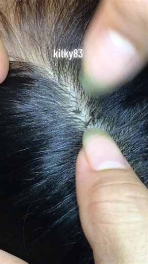 remove lice#omg❤️❤️❤️😍💕😍 #lice ❤️❤️❤️#liceremoval🙈🙈🙈😅