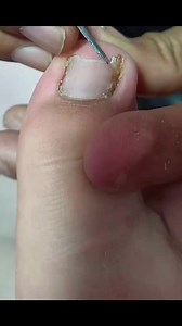 671K views · 4.7K reactions | #Shorts #toenailroomb Big Toenail Removal & Pedicure Treatment #12882 #Reels | Atlas Professional Risk Management | Facebook