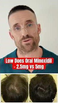How effective is low dose oral Minoxidil for androgenic alopecia? #Minoxidil #hairloss #hair #STEM