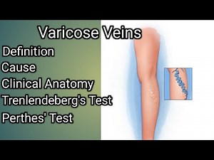 Varicose veins