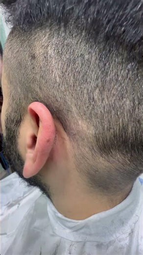 Skincare satisfying videos #pimple #pimples #pimplepopping #acne #blackheads #hairremoval
