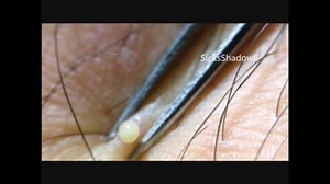 ニキビ潰しプチプチ10連発ァ！！