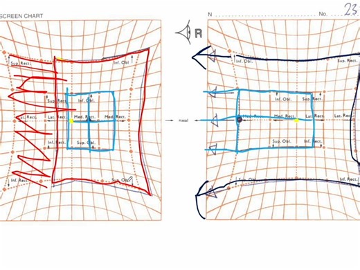 Hess屏检查 | Hess Chart - Interpretation