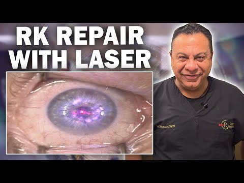 Radial Keratotomy Laser Repair on the Cornea