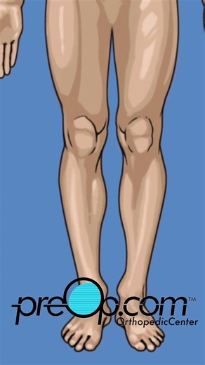🔍 PreOp® Knee Replacement Surgery 💡 Insight That Empowers Care ✨ #shorts