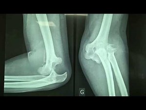 réduction d'une luxation de coude aux urgences/reduction of elbow dislocation/خلع الكوع