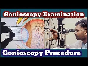 Gonioscopy examination / Gonioscopy / ophthalmology hindi video / goniolens / goniolens examination