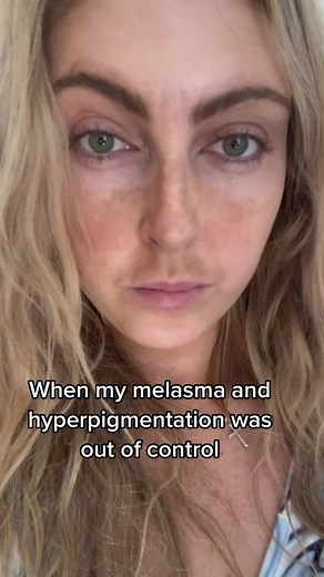 My hyperpigmentation/melasma journey has been a wild one. Started use a cream with 3 different ingredients and it has transformed my skin and confidence ❤️‍🩹 #hyperpigmentation #hyperpigmentationtreatment #hyperpigmentationtips #melasmatreatment