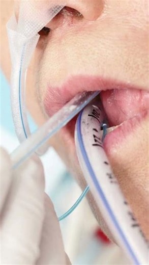 Suction Catheter