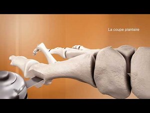 L'ostéotomie en chevron - Chirurgie du pied - Clinique du Parc Lyon