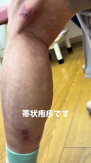 #帯状疱疹#皮膚科 #皮膚科専門医 #皮膚科クリニック #帯状疱疹ワクチン
