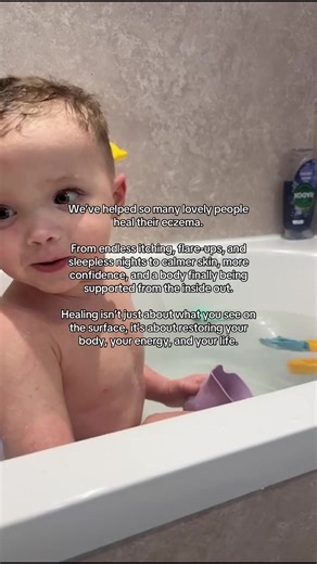 At Reformed Wellbeing, we use bioenergetic testing to look at up to 10,000 health markers in your body, giving us insight into the root drivers of eczema that you might not even be aware of. We know how frustrating it can be when creams and steroids only provide temporary relief, that’s why our focus is on healing naturally, no quick fixes, no masking symptoms, and getting to the underlying causes of your flare-ups. Skin inflammation can be triggered by a wide variety of internal factors, includ