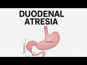 DUODENAL ATRESIA | AETIOLOGY | CLINICAL FEATURES | PATHOLOGY | TREATMENT | OUTCOME
