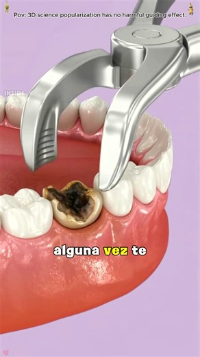 Tooth Extraction Procedure Explained Step-by-Step#toothextraction #DentalCare #dentalprocedure