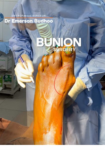 Bunion Correction Surgery: A Step-by-Step Guide