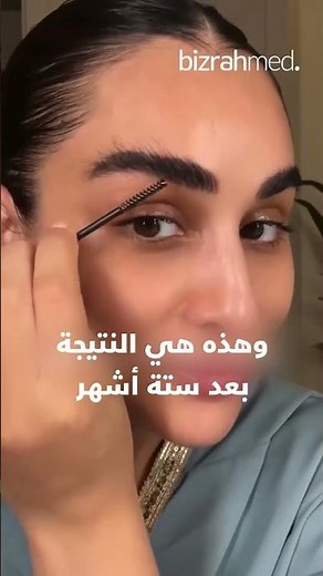 Eyebrow Transplant Surgery: Before and After Results - Bizrahmed Centre